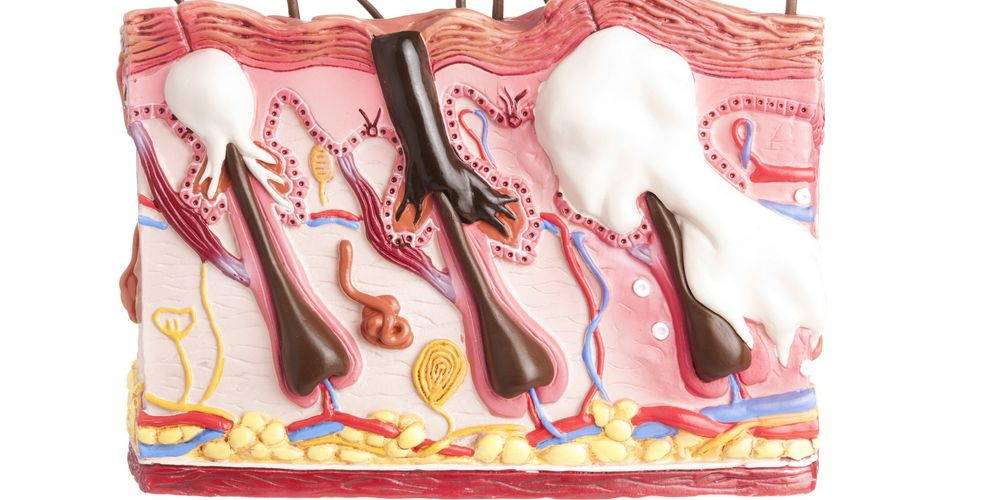 Internal causes of acne