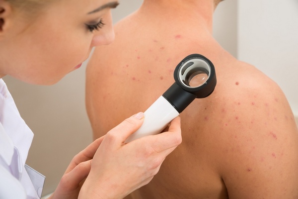Comment se débarrasser de l’acné sur le corps?
